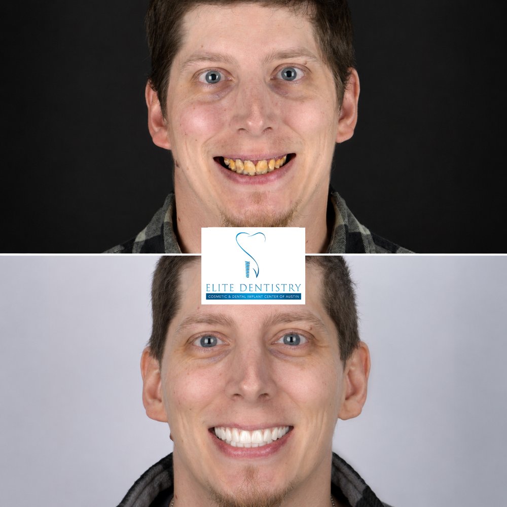 Before and after portraits of a young male patient: crowded, discolored teeth before, and a bright new smile after
