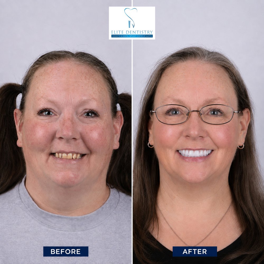 Before and after portraits of a female patient: worn, discolored teeth before, and a bright new smile after