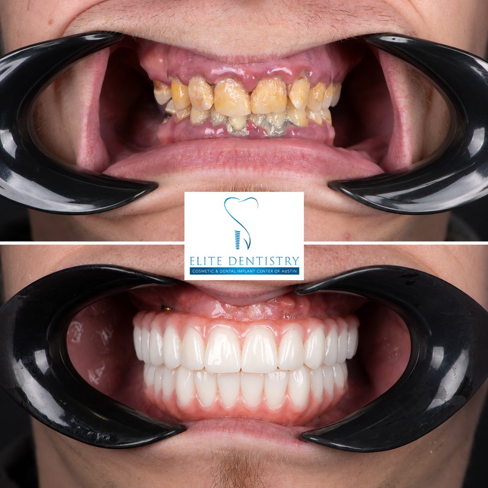 Intraoral before and after of a male patient: decayed, discolored teeth and inflamed gums before, and new full upper and lower arches after