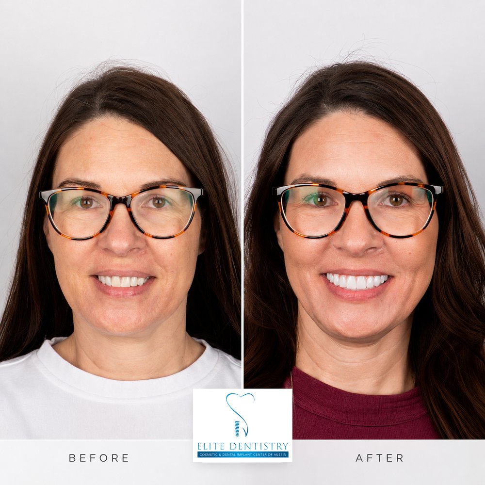 Before and after portraits of a female patient wearing glasses, showing her smile before and her new smile after