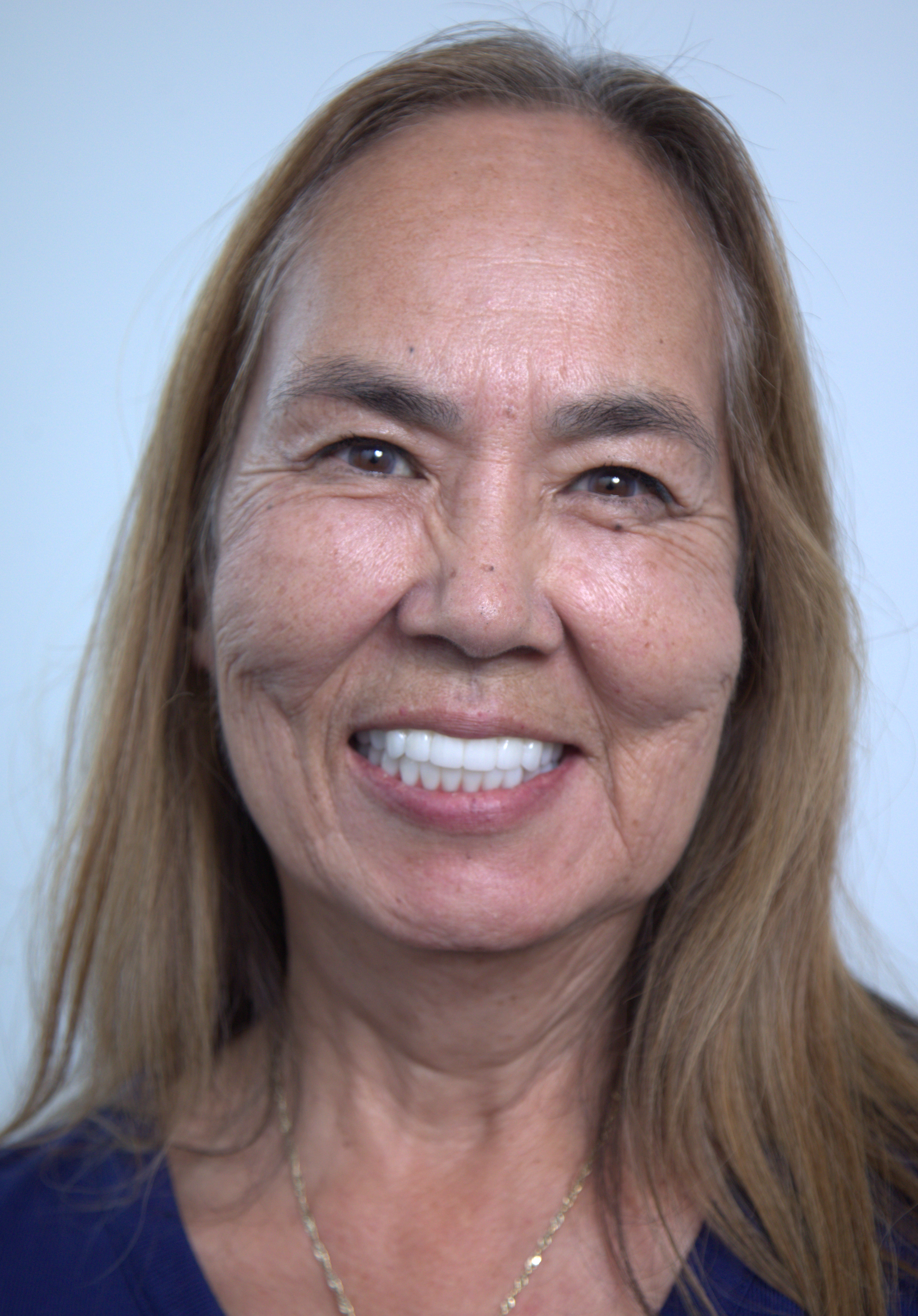 Patient smile after dental implant treatment