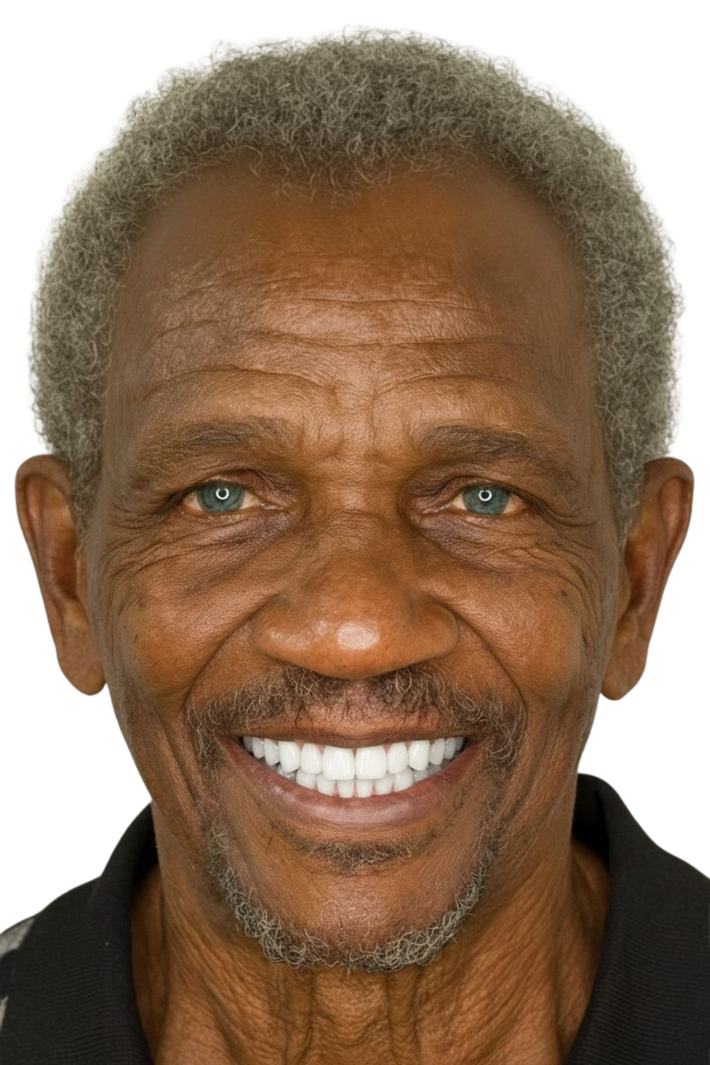 SmileGen visualization of the same patient after treatment