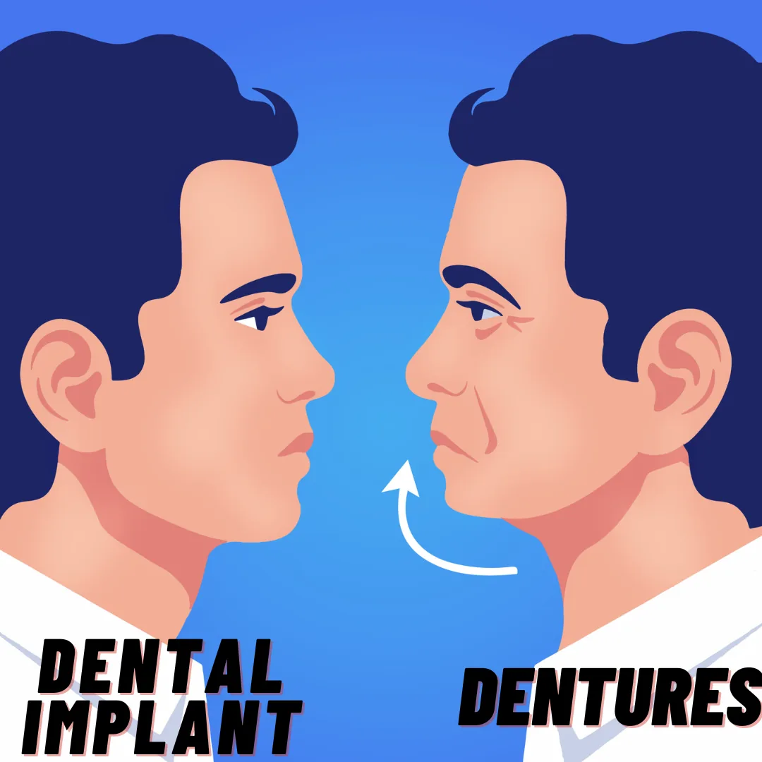A BiteBot dental ad comparing implants versus dentures with side-by-side illustration.