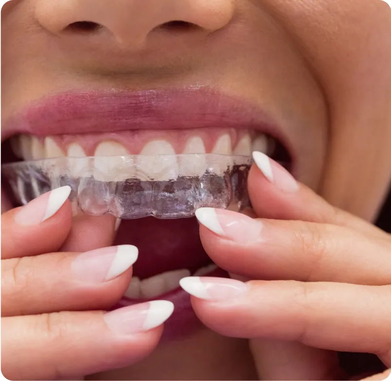 Aparelho Transparente