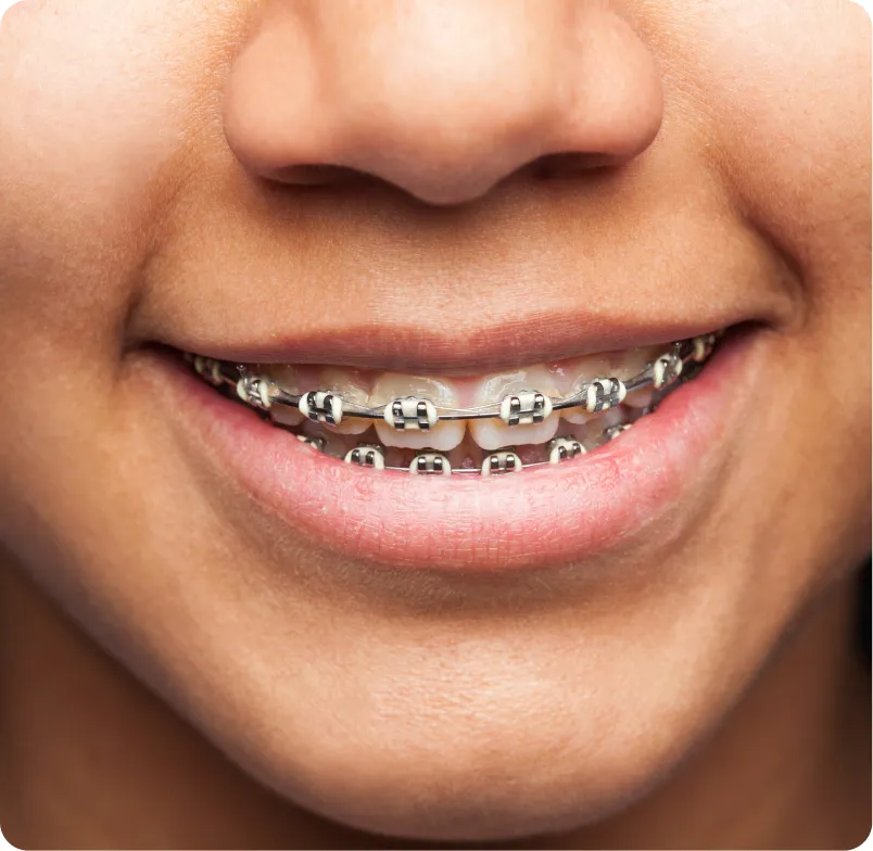 Aparelho Convencional