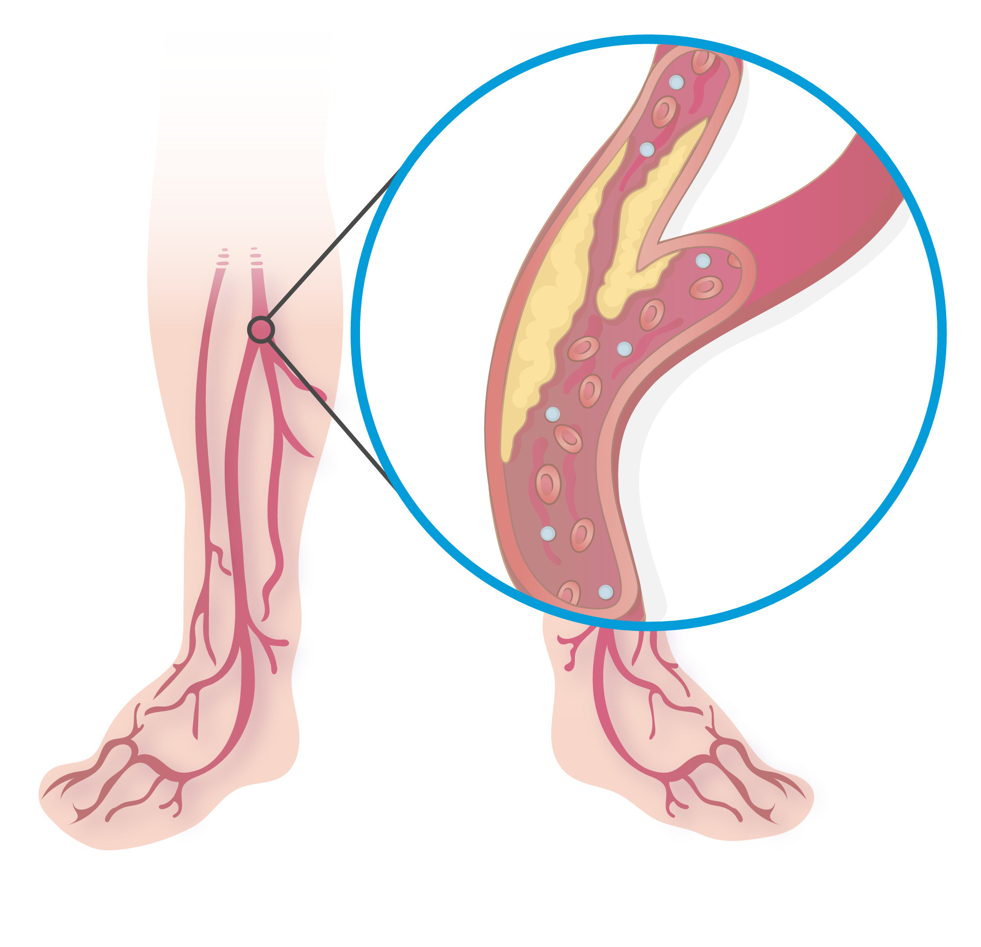 diagram showing peripheral neuropathy and blood vessels not working
