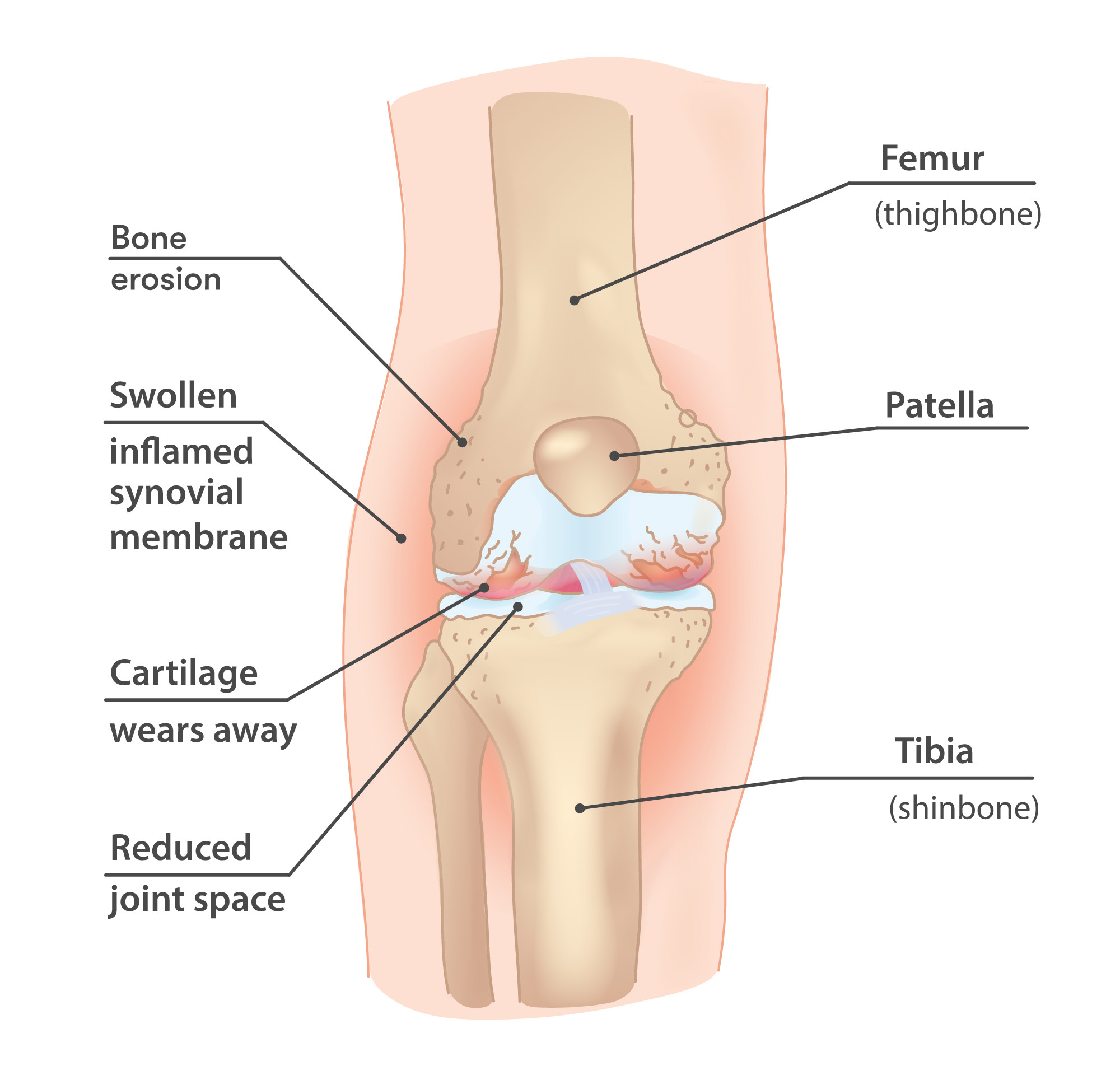 diagram of knee joint to better understand knee pain and services to help