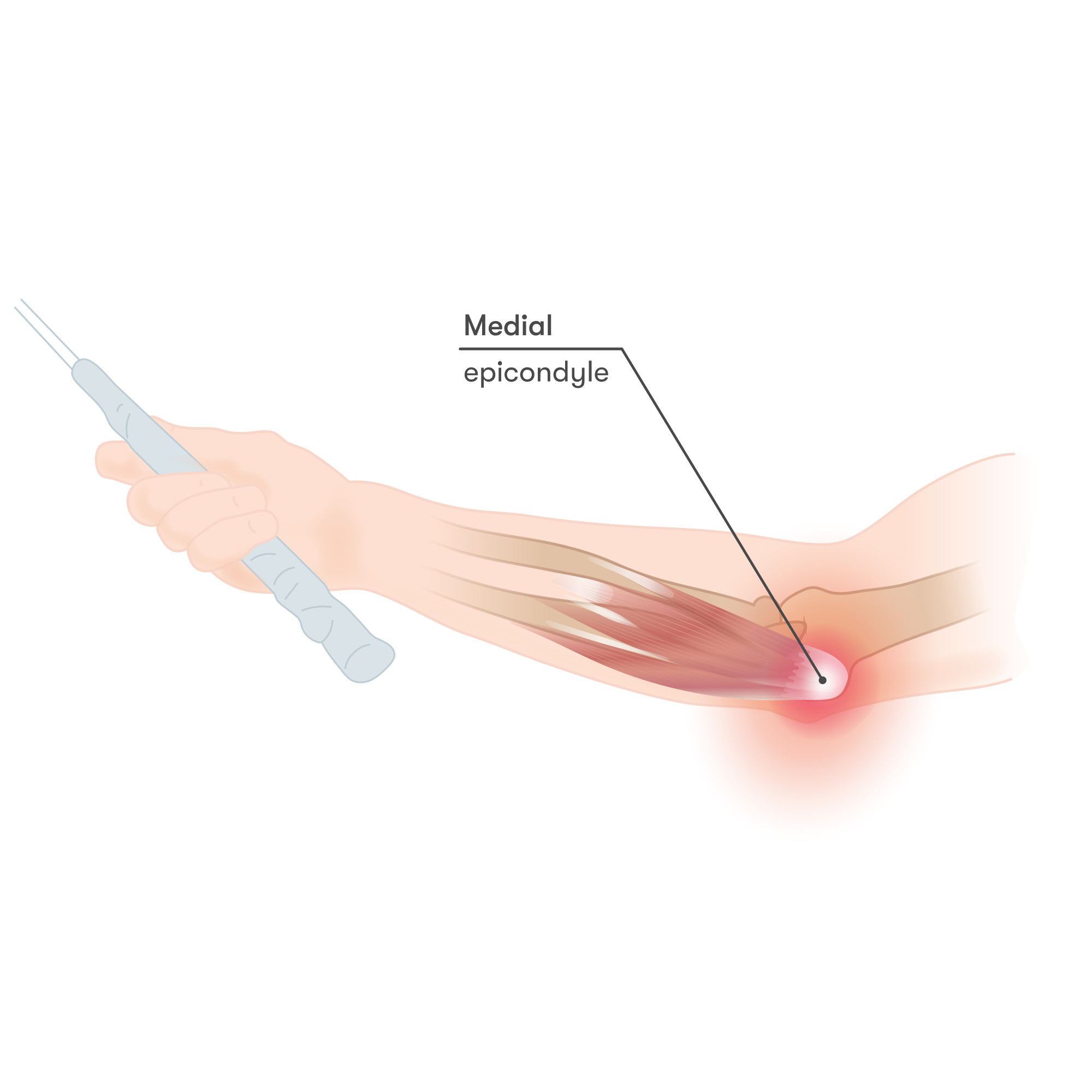 diagram of Elbow with pain before shockwave therapy helps tennis elbow pain