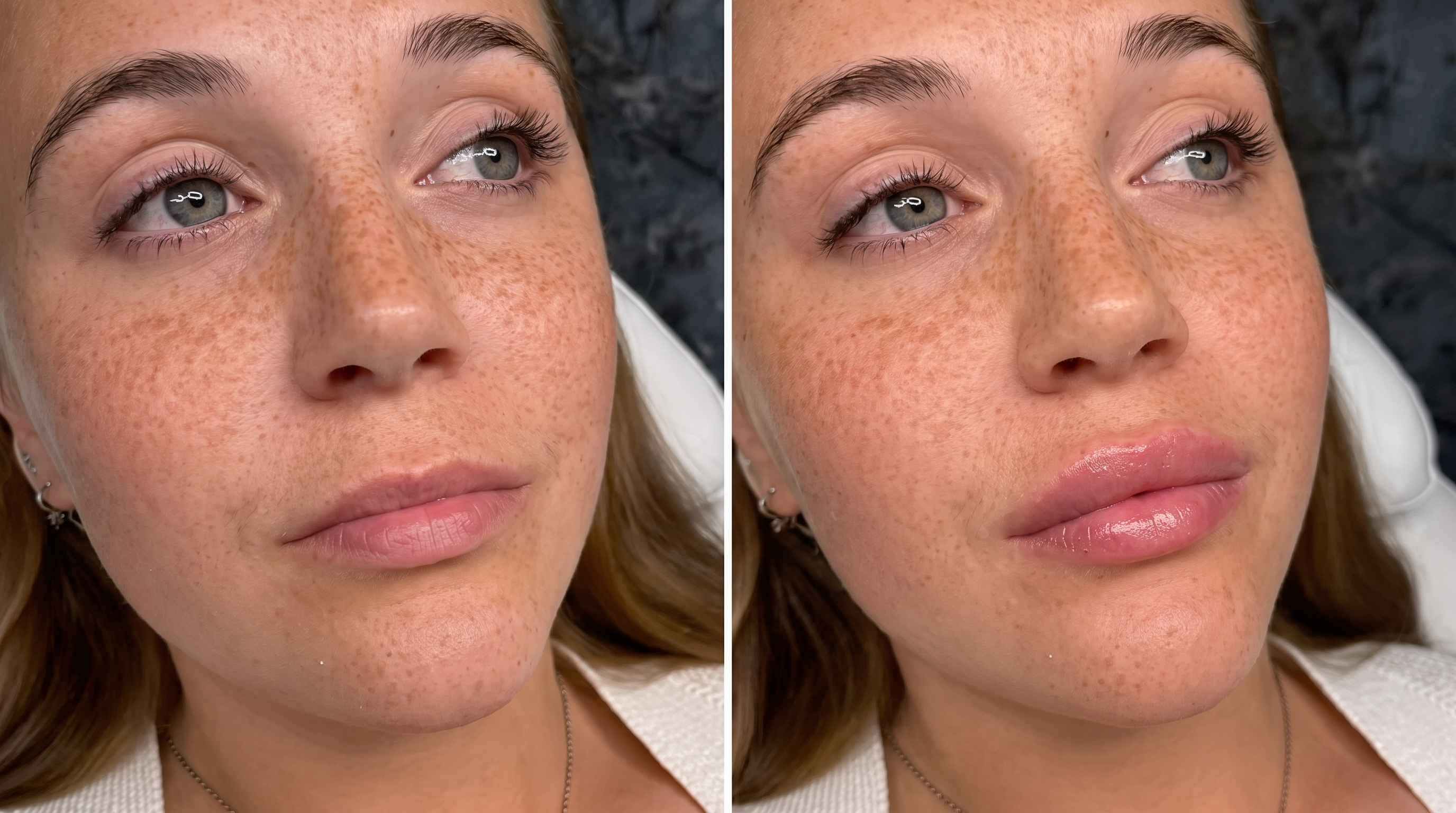 Exempel på ett naturligt resultat hos LaVita Clinic
