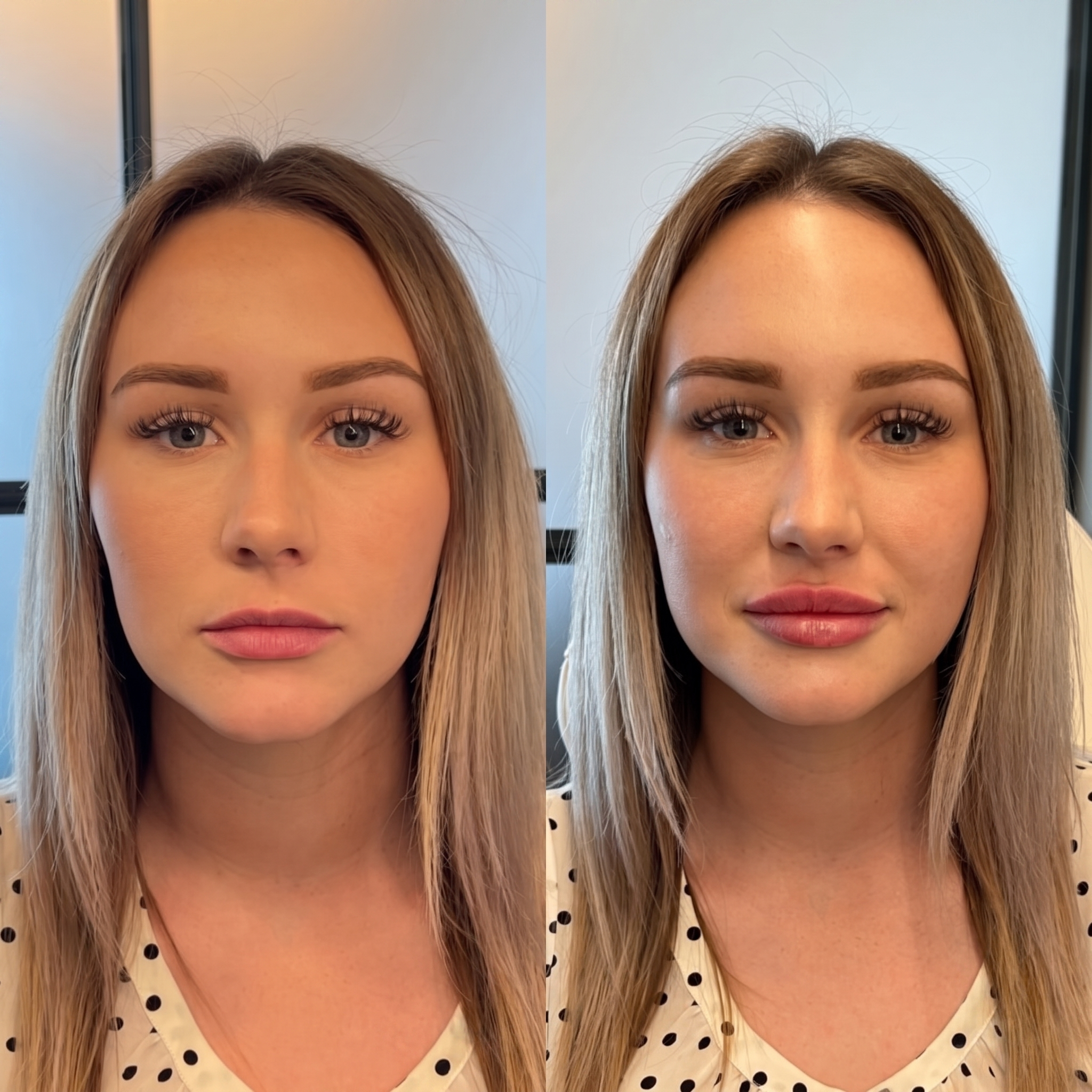 Exempel på ett naturligt resultat hos LaVita Clinic