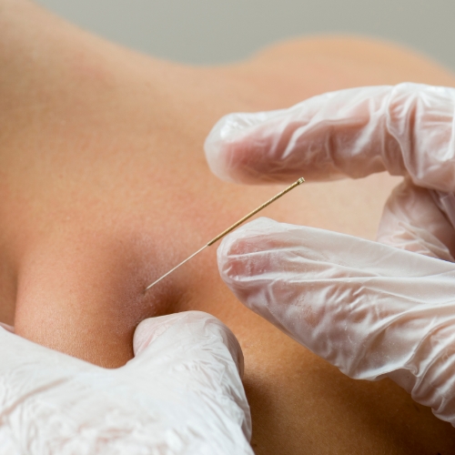 Dry needling treatment in Ottawa and Orléans