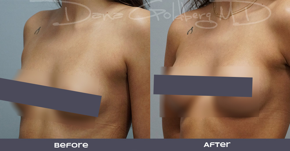Breast augmentation before and after