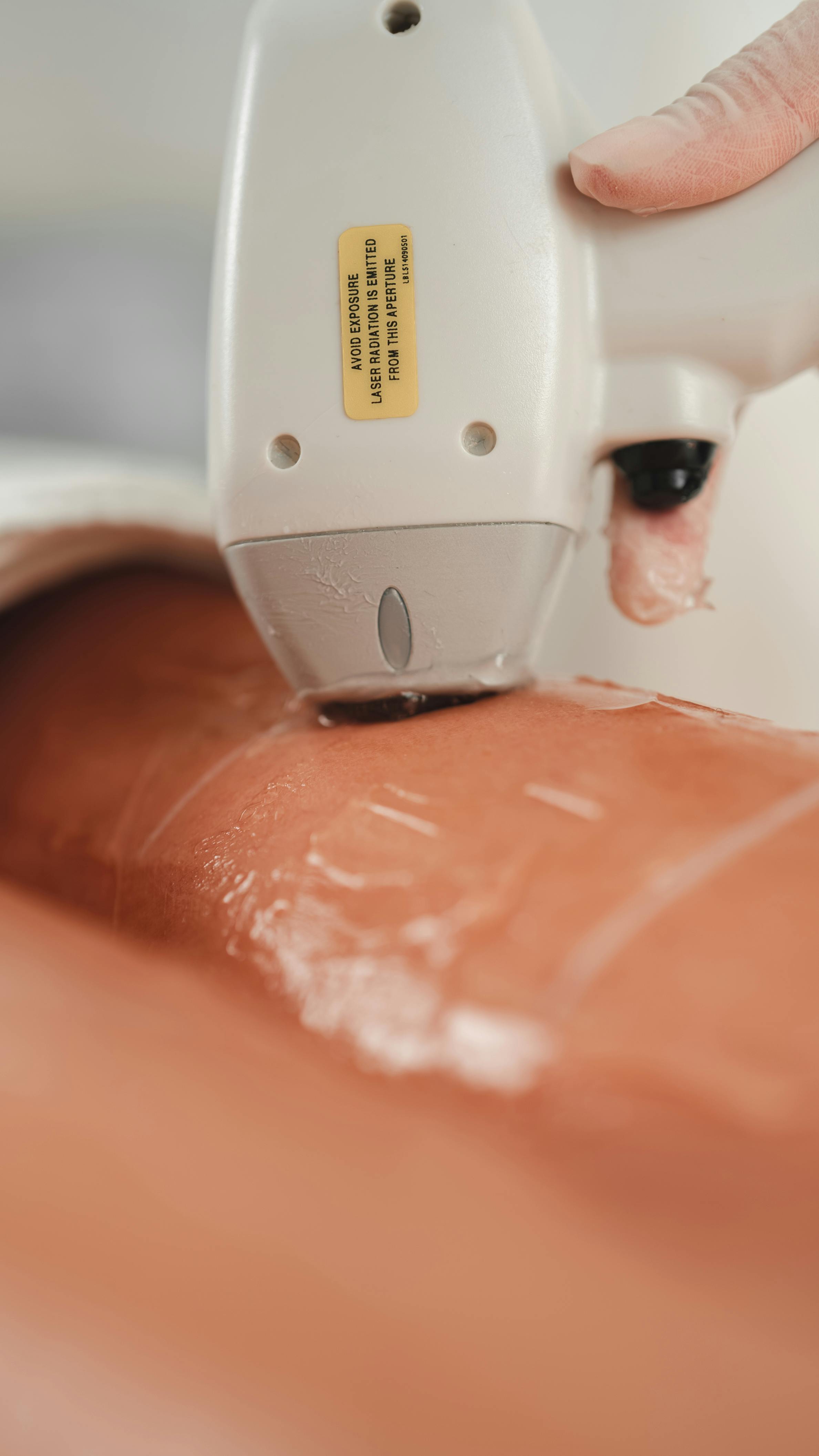 Permanent Hair Removal