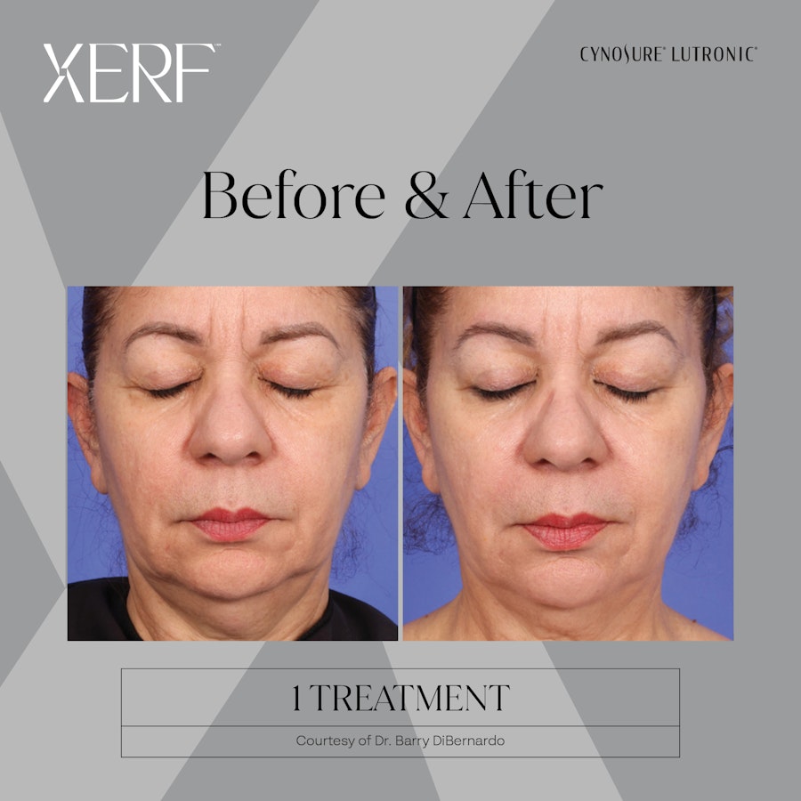 Xerf resurfacing result