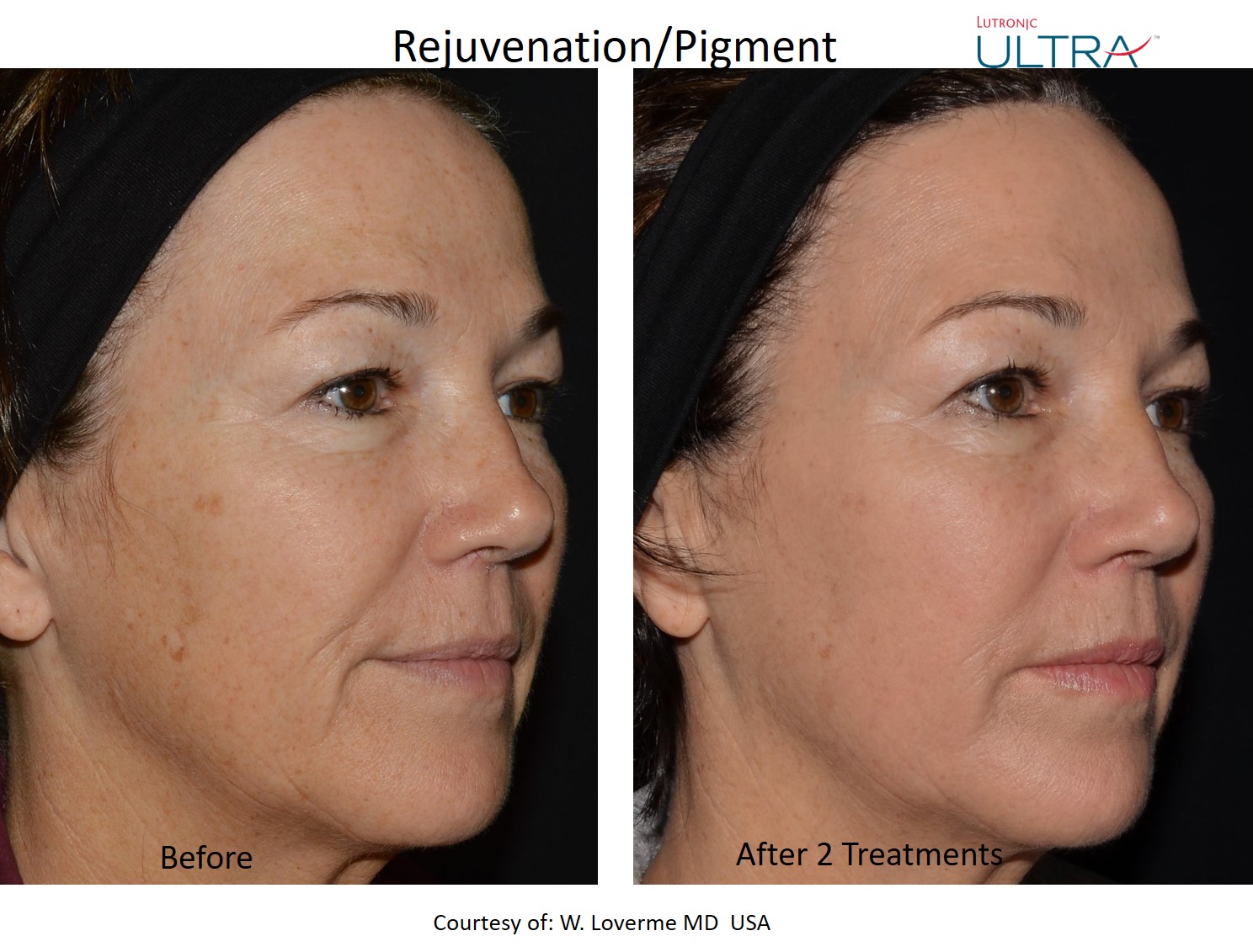 Ultra fractional resurfacing result