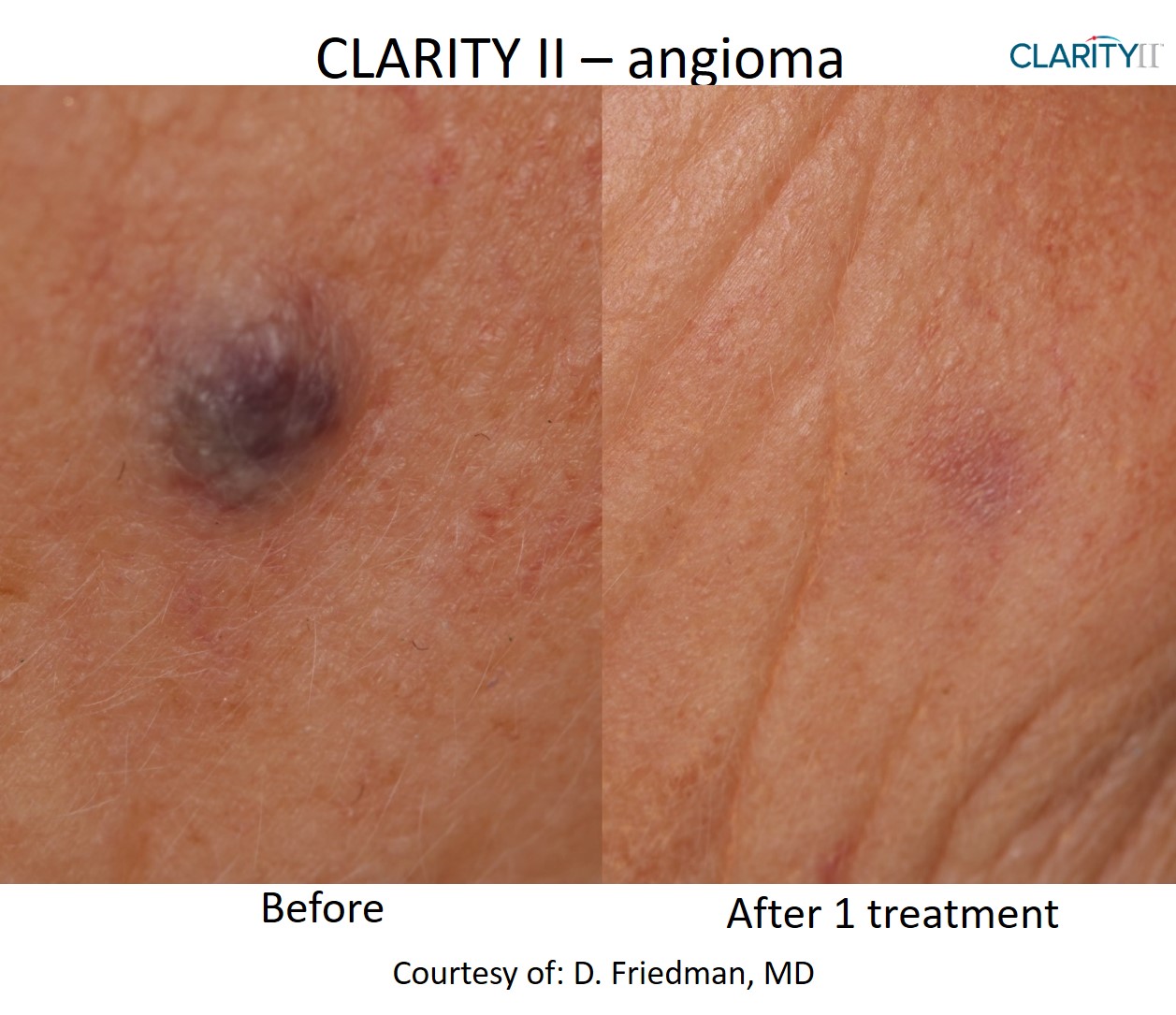 Clarity II pigmentation correction result