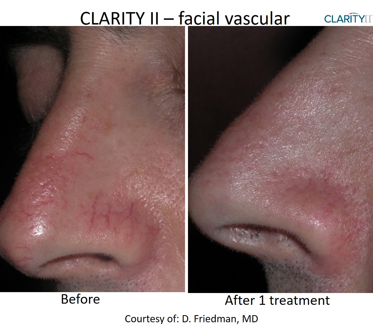 Clarity II laser hair removal result