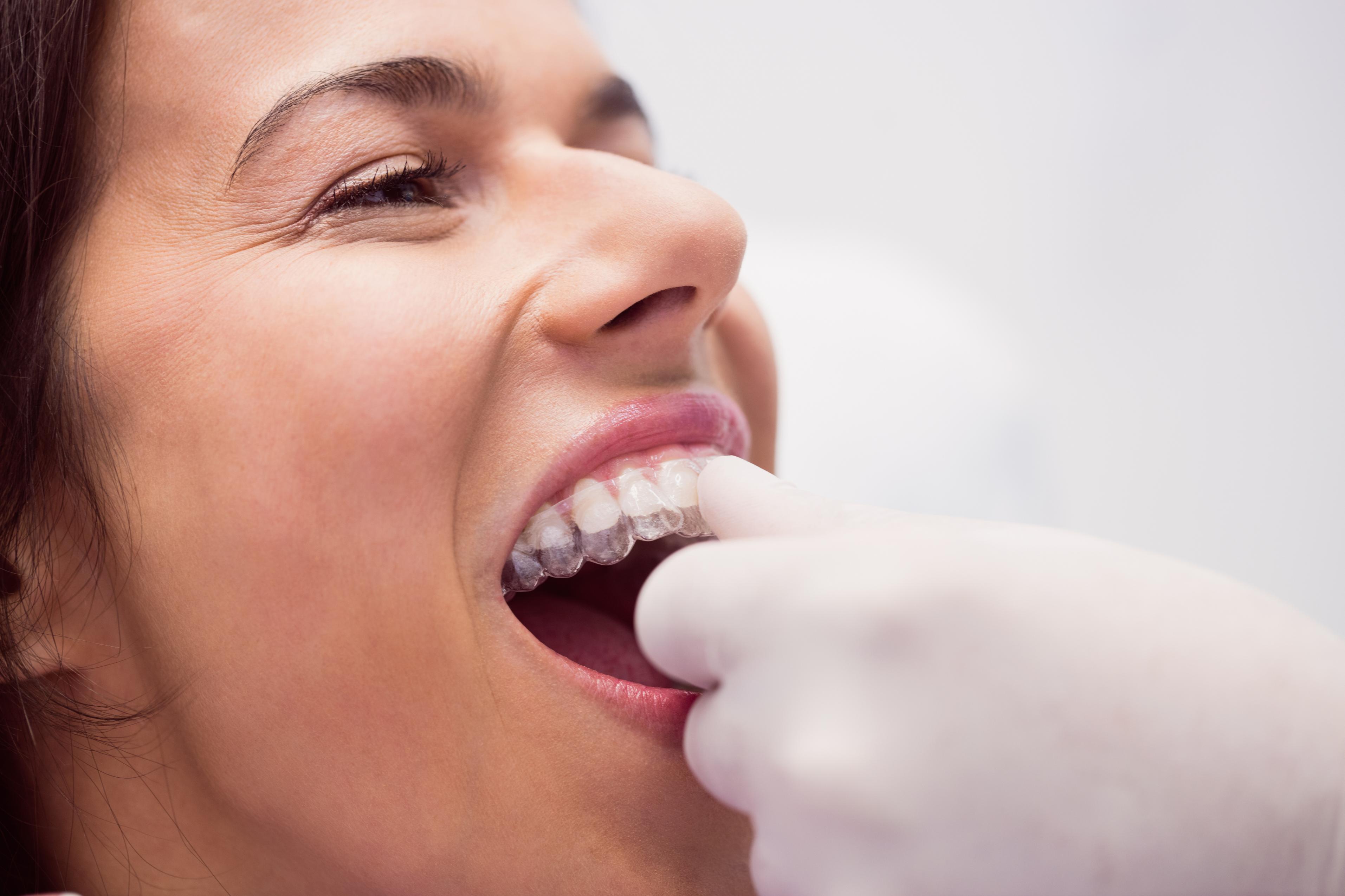 Clear Aligner Treatment in Changanassery