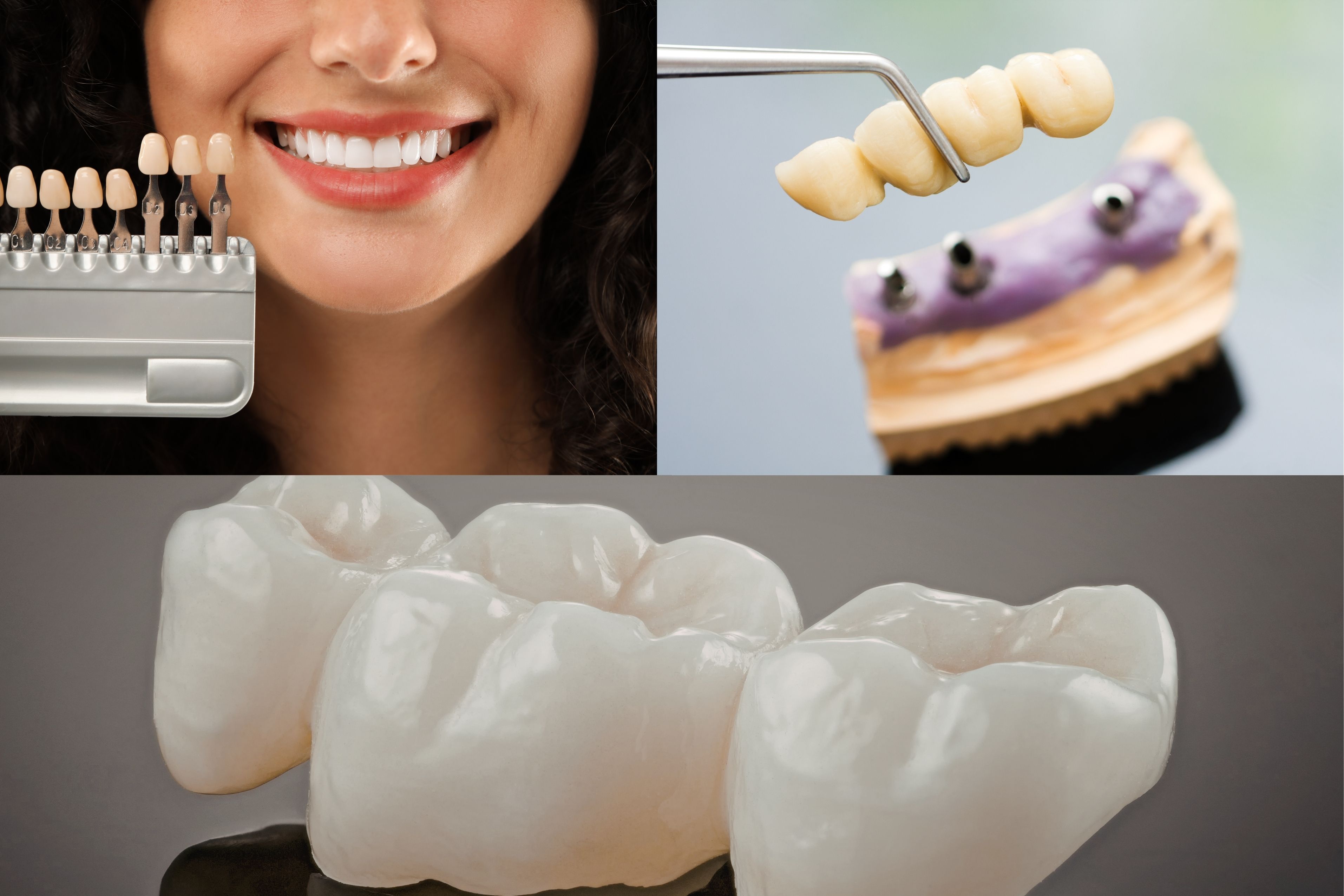 Dental Crowns and Bridges in Changanassery