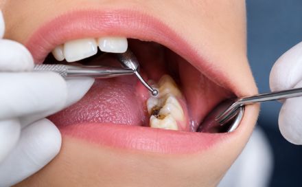 Restorative Dentistry in Changanassery
