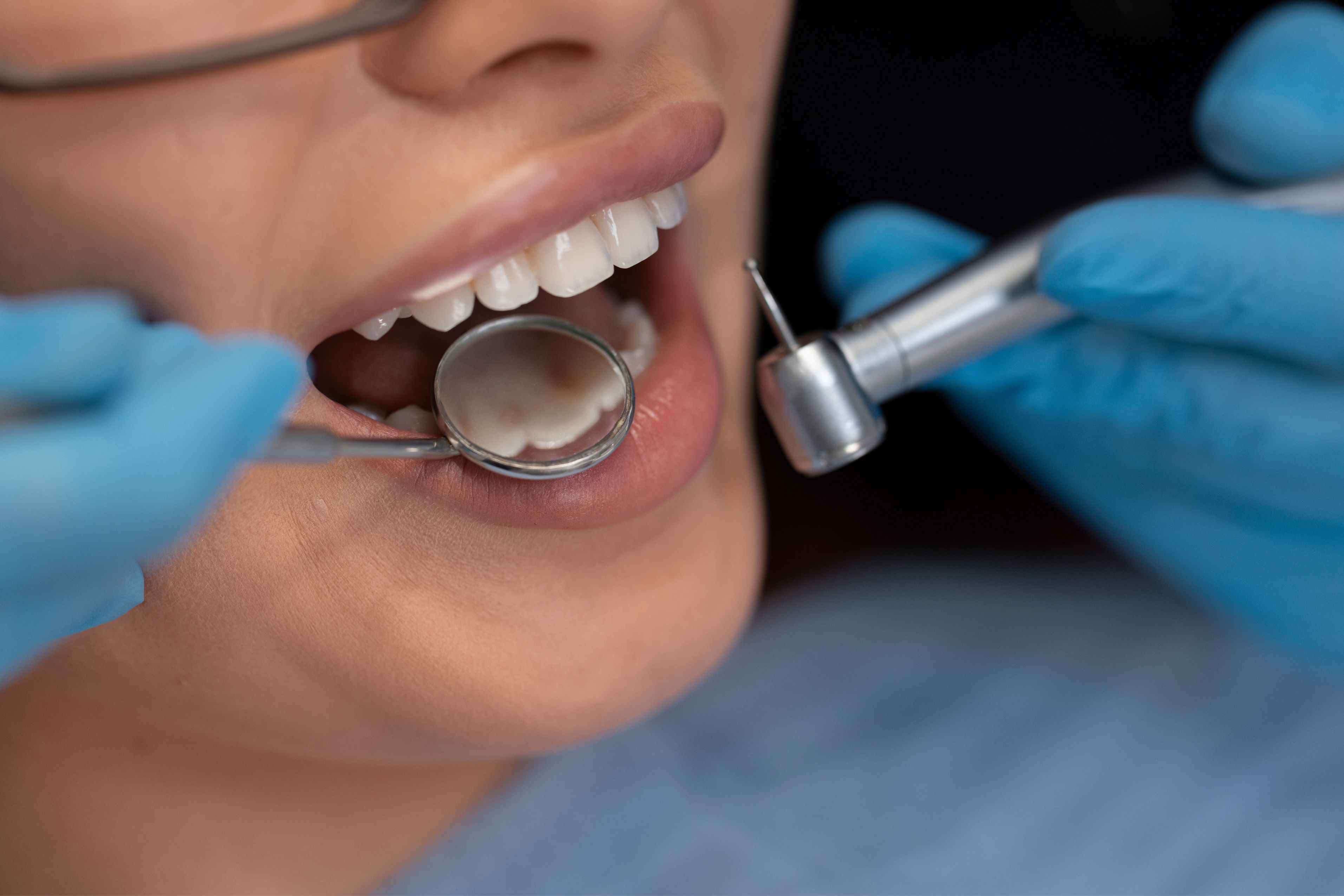 Dental Filling Treatment in Changanassery