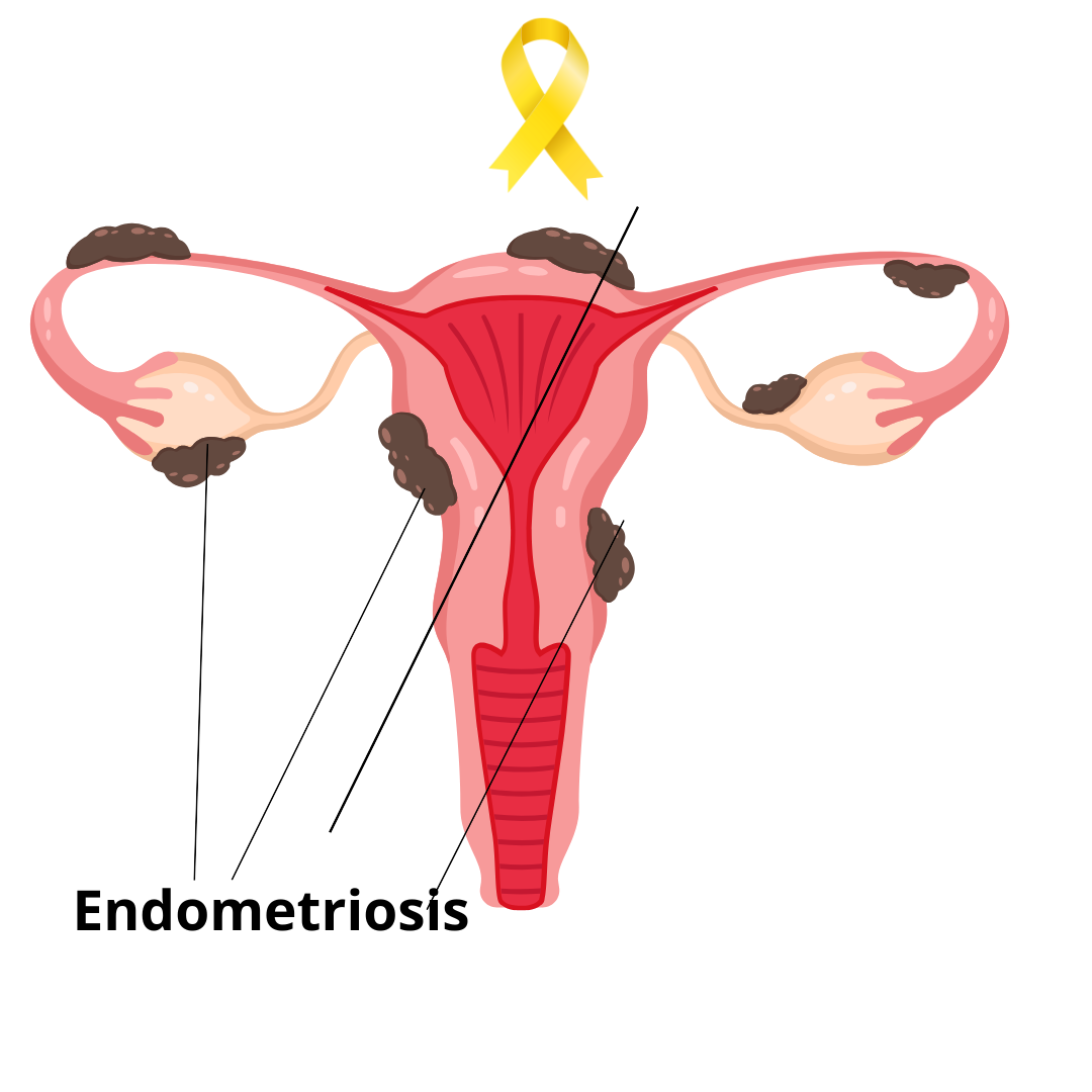Endometriosis