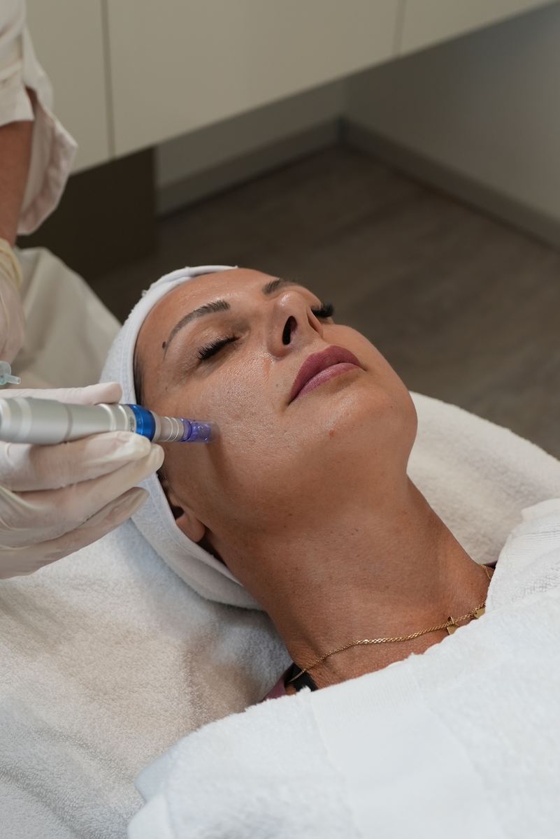 microneedling