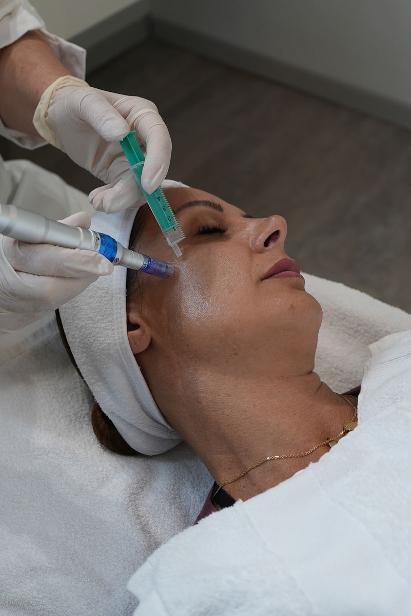 microneedling