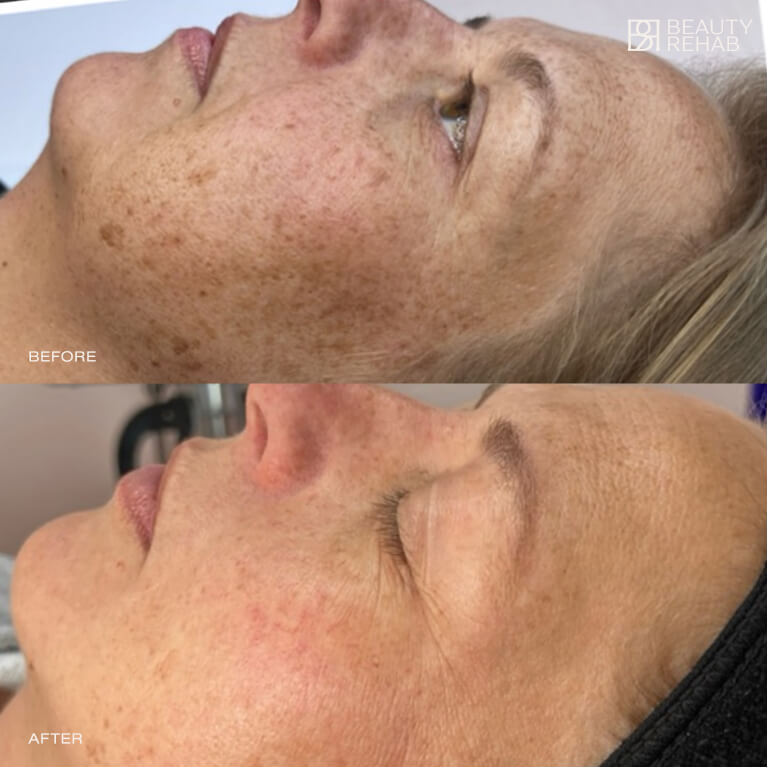 Before and after laser treatment at The Beauty Rehab