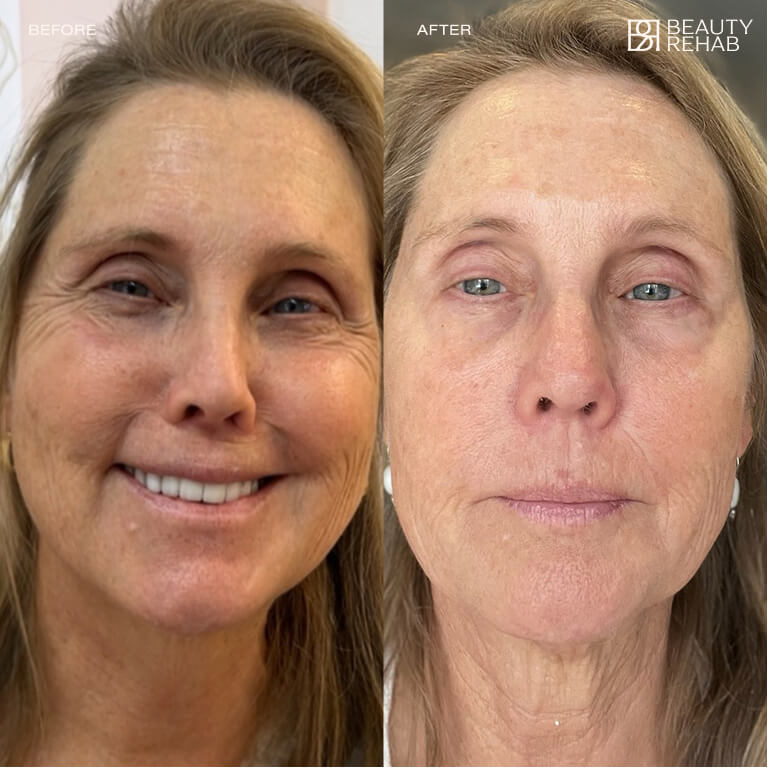 Before and after laser treatment at The Beauty Rehab
