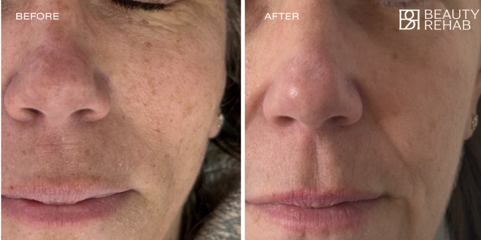 Before and after laser treatment at The Beauty Rehab