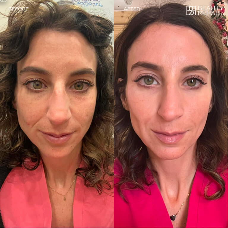 Before and after laser treatment at The Beauty Rehab