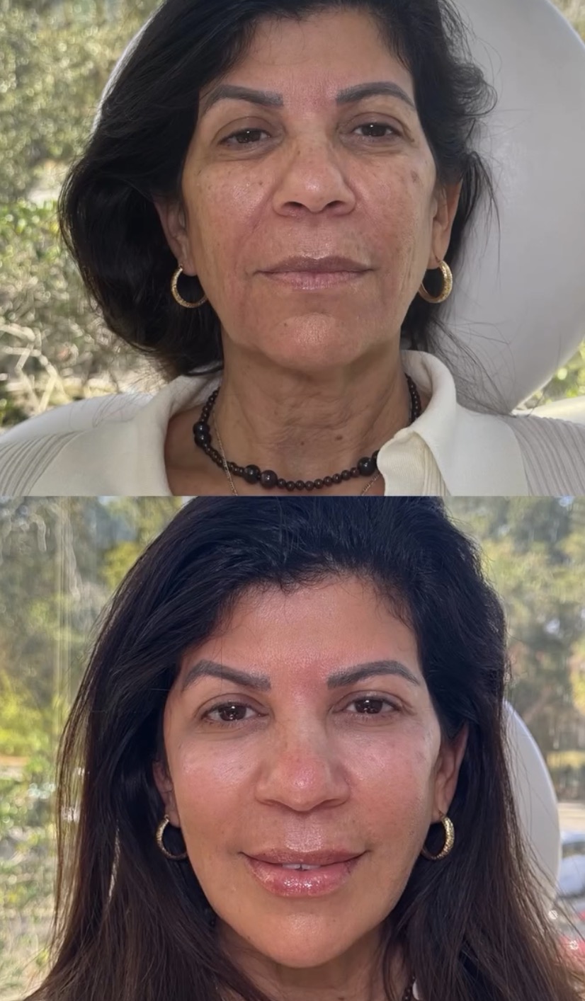 A Lume client before and after a series of facials