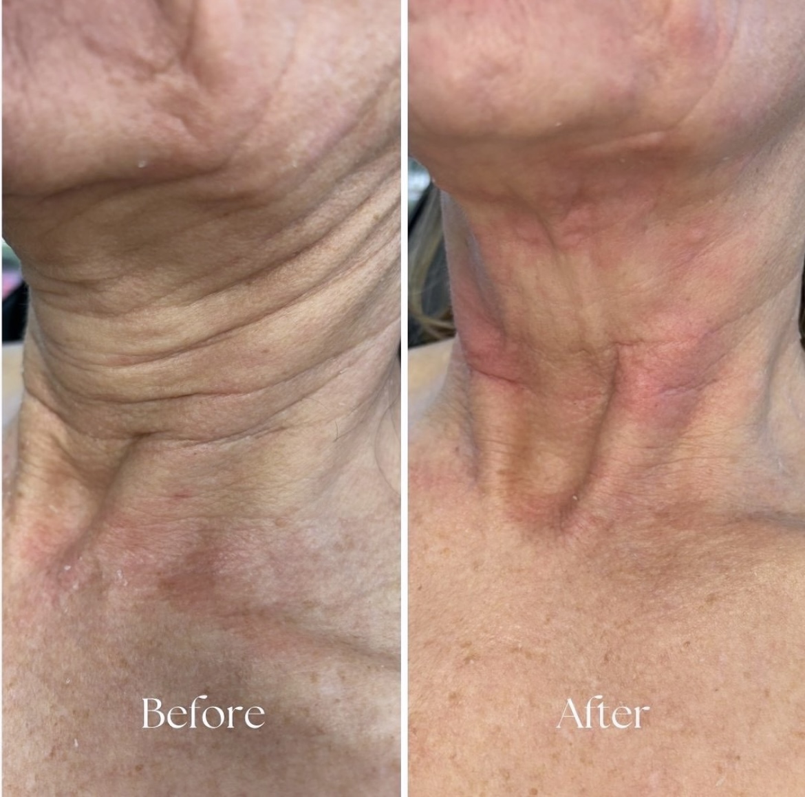 A Lume client before and after a series of facials