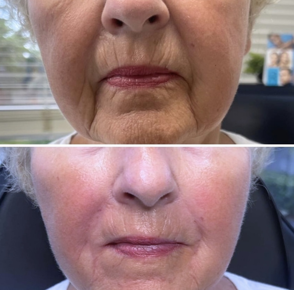 A Lume client before and after a series of facials