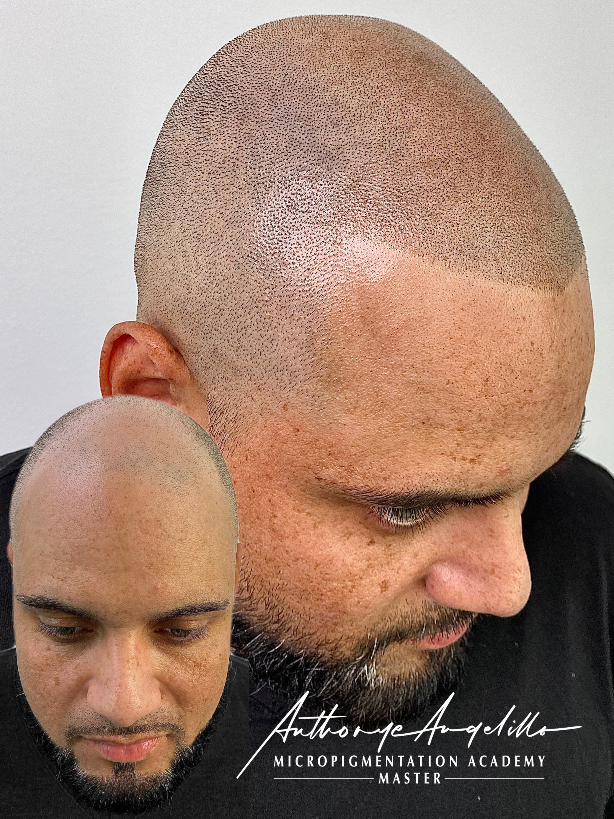 Scar Camouflage
