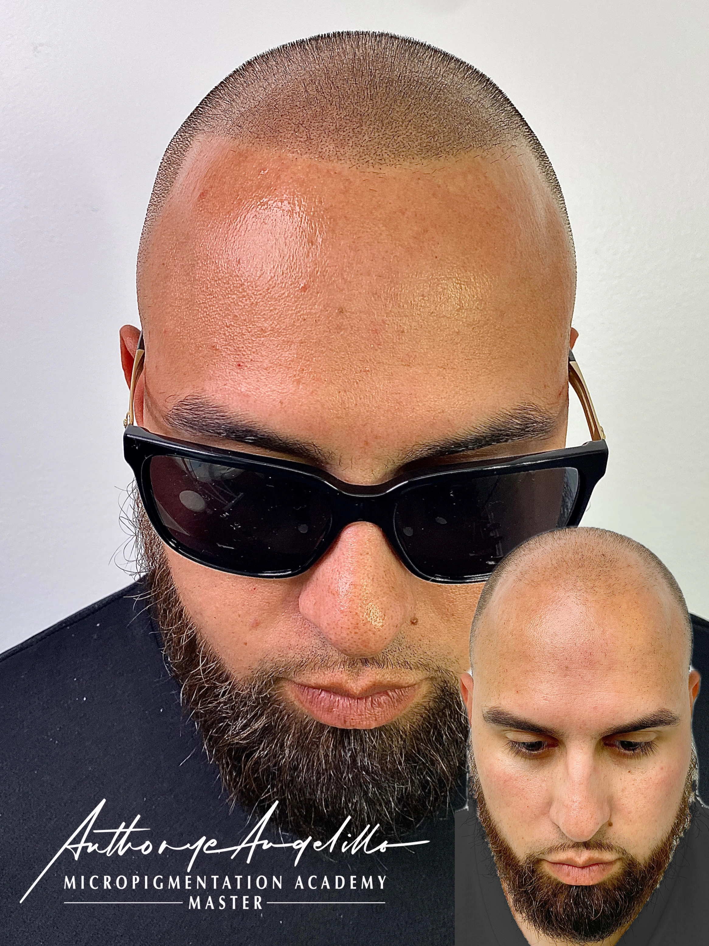 Scalp Micropigmentation Result 11