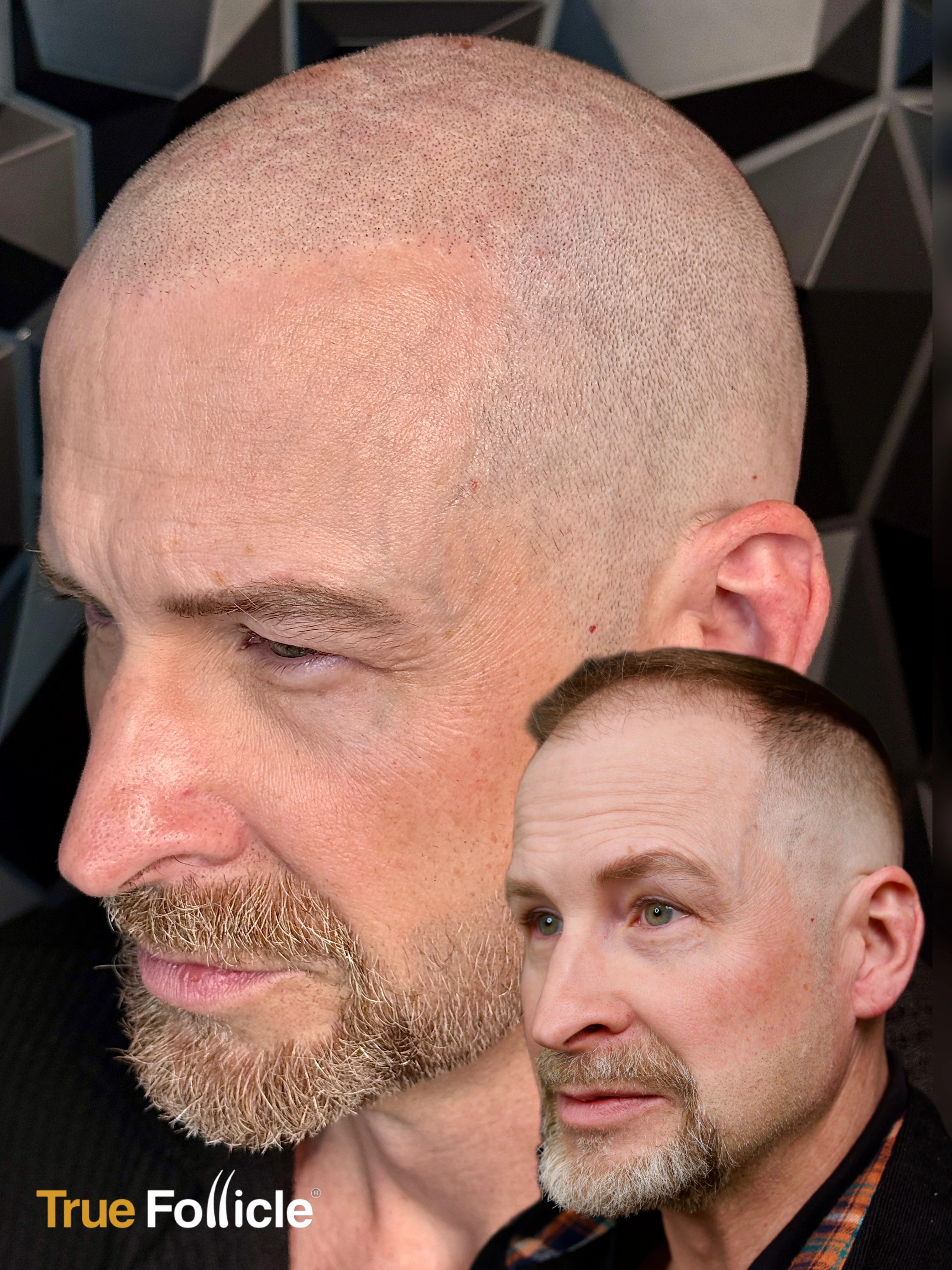 Scalp Micropigmentation Result 15