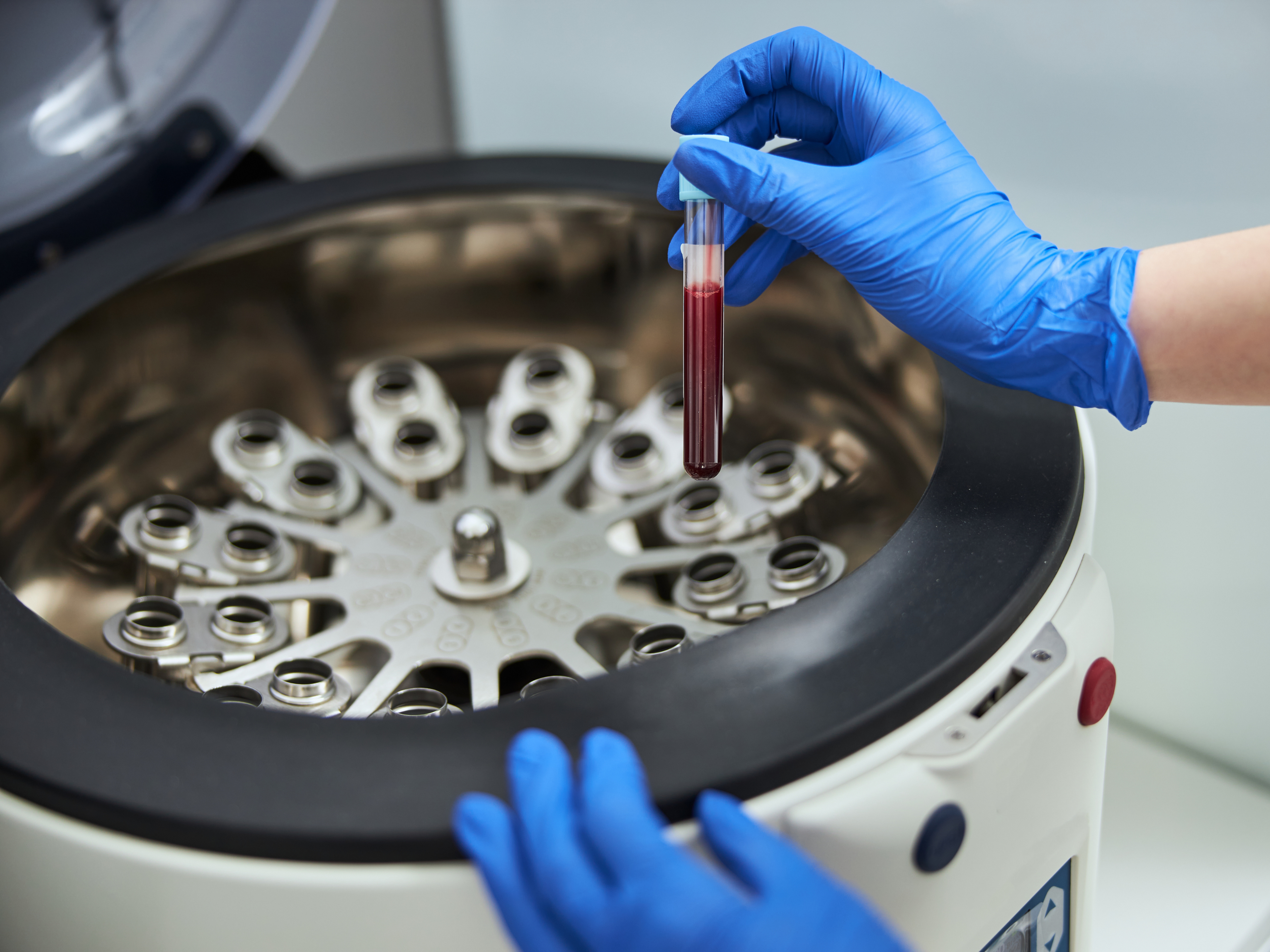 PRP treatment
