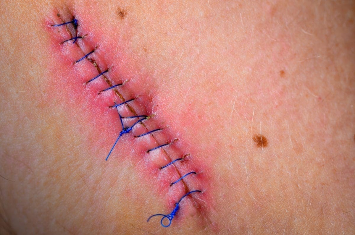 Post surgical slow healing