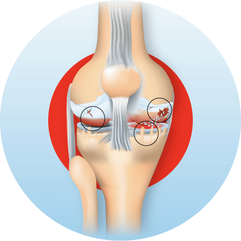 Knee osteoarthritis