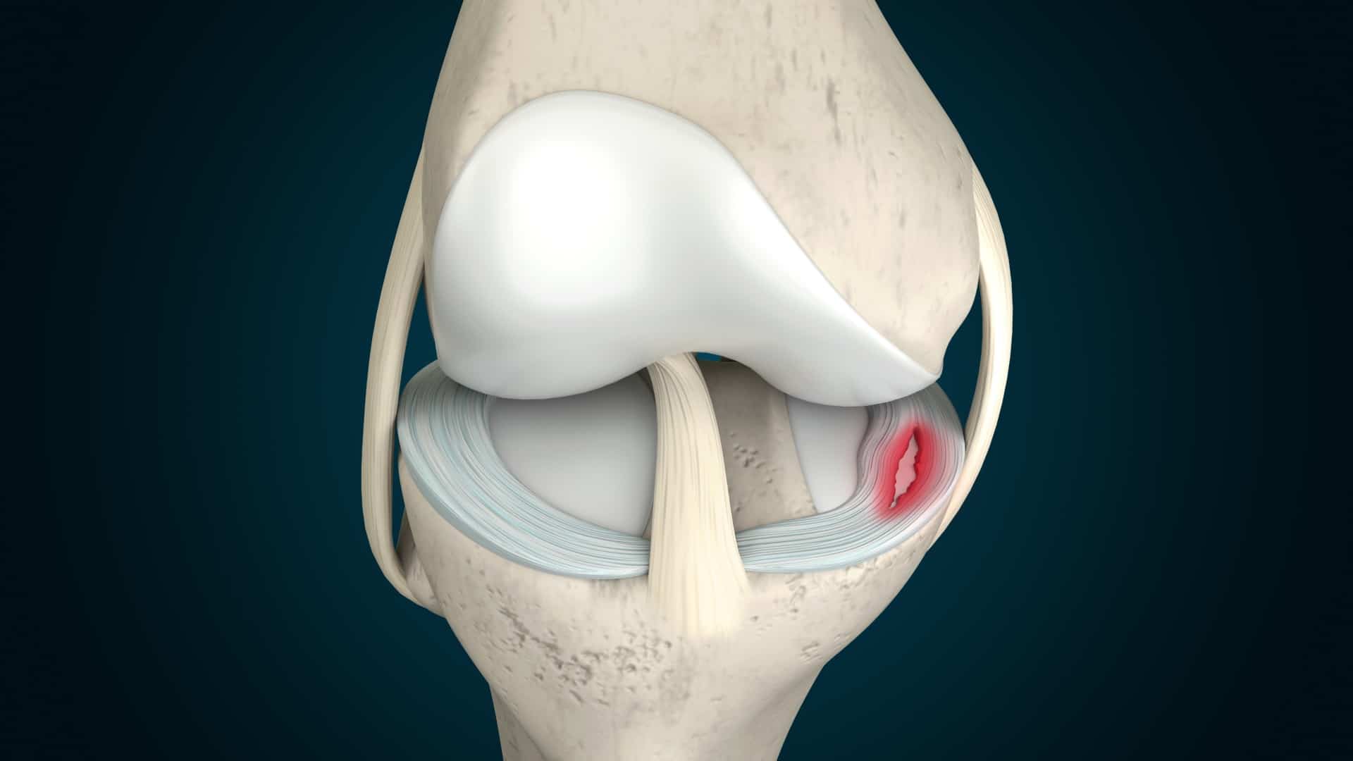 Meniscus damage
