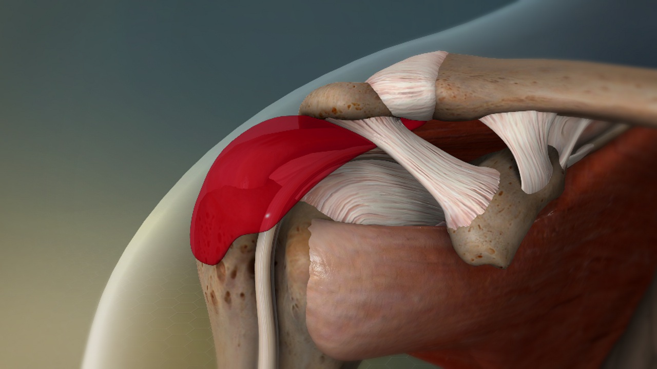 Shoulder bursitis