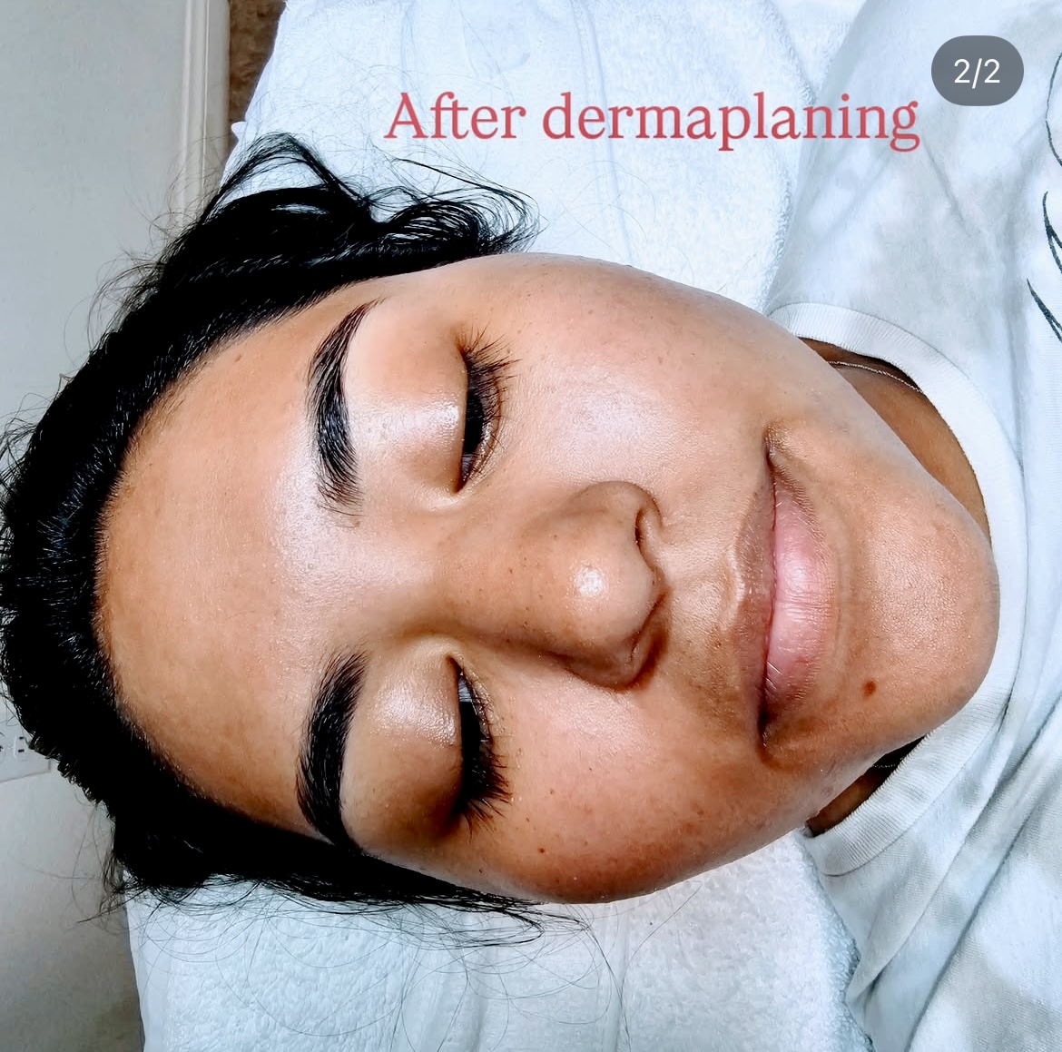 Dermaplaning Client