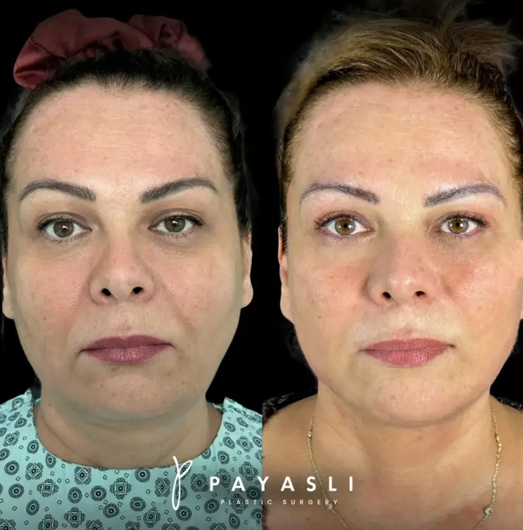 Yüz gençleştirme — öncesi ve sonrası