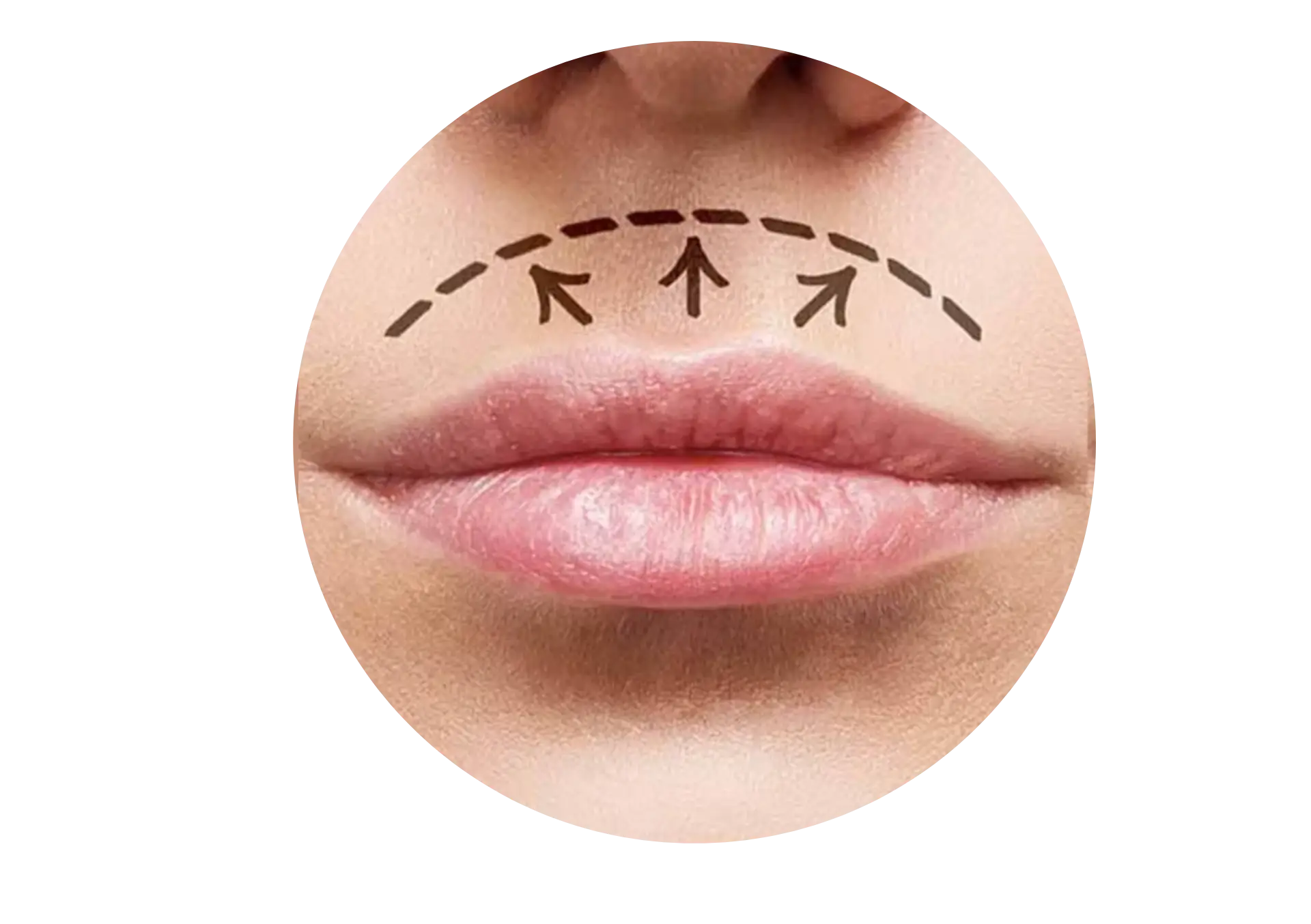 LipLift (Üst Dudak Kaldırma)