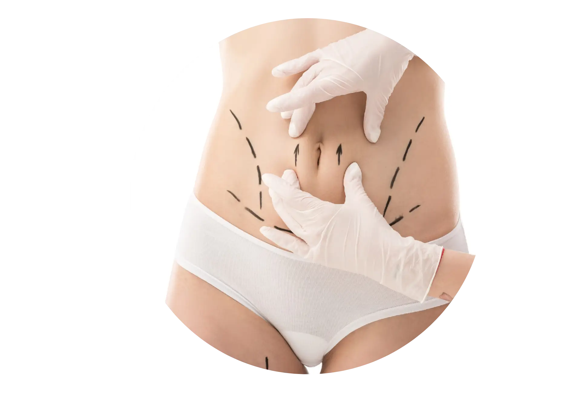 Yağ Aldırma (Liposuction)