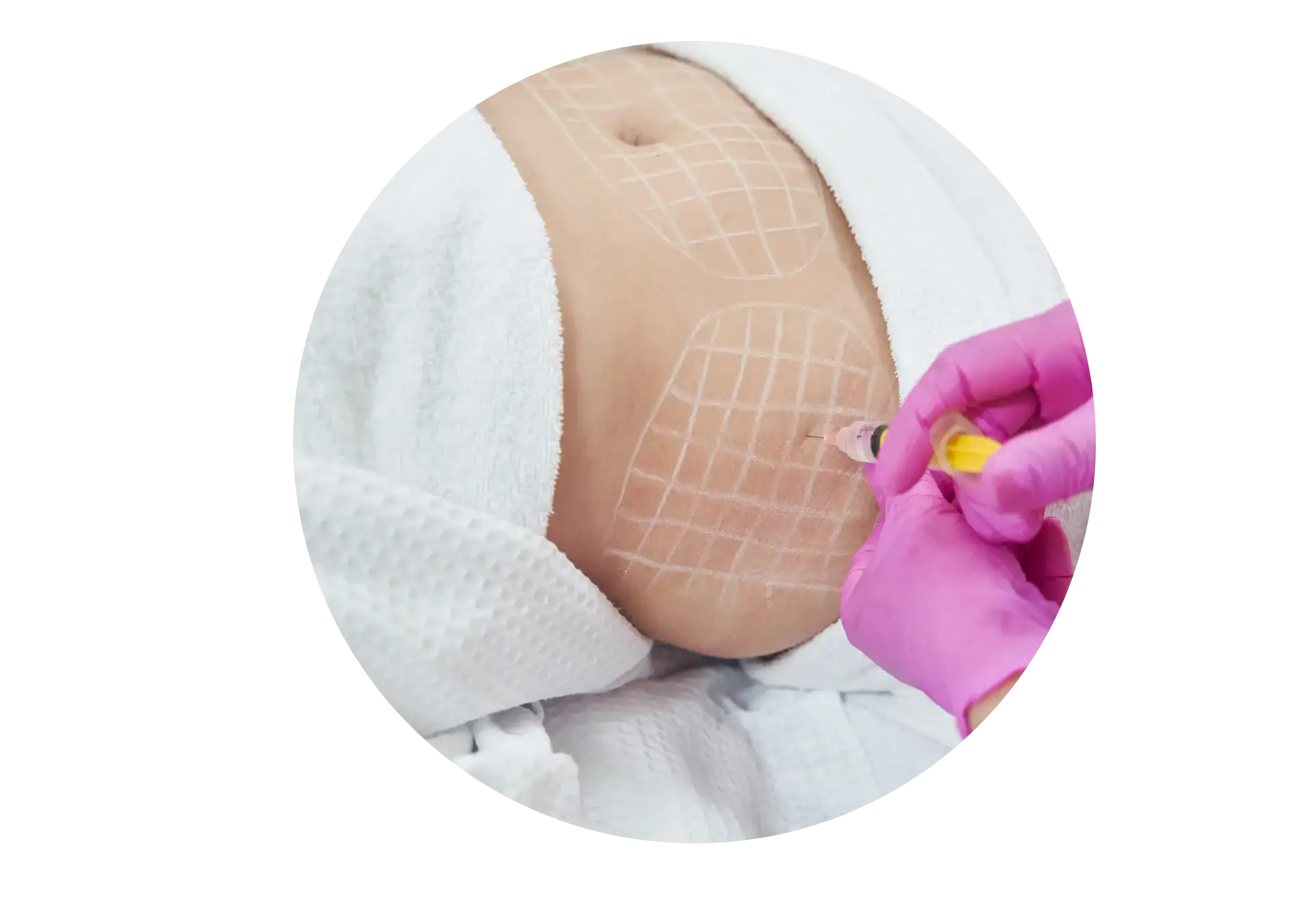 Yağ Enjeksiyonu (Lipofilling)