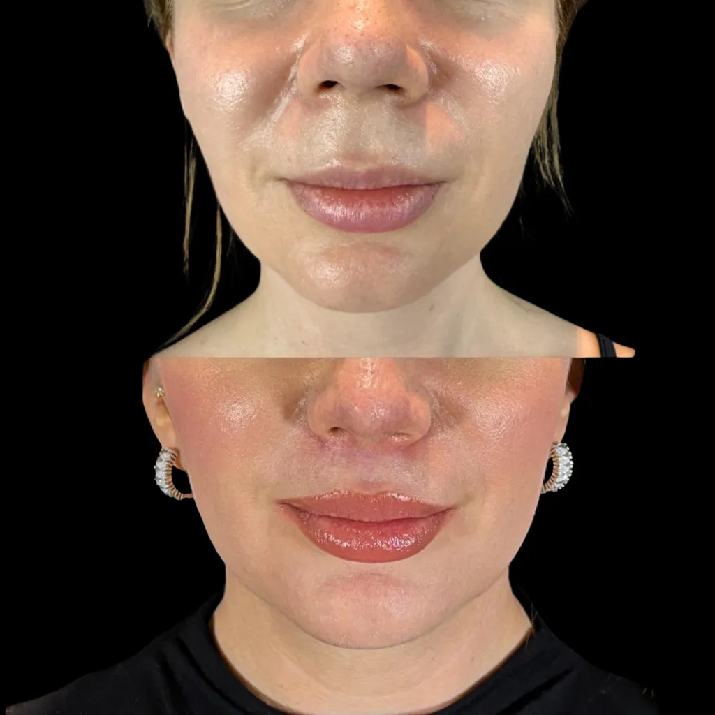 LipLift — öncesi ve sonrası