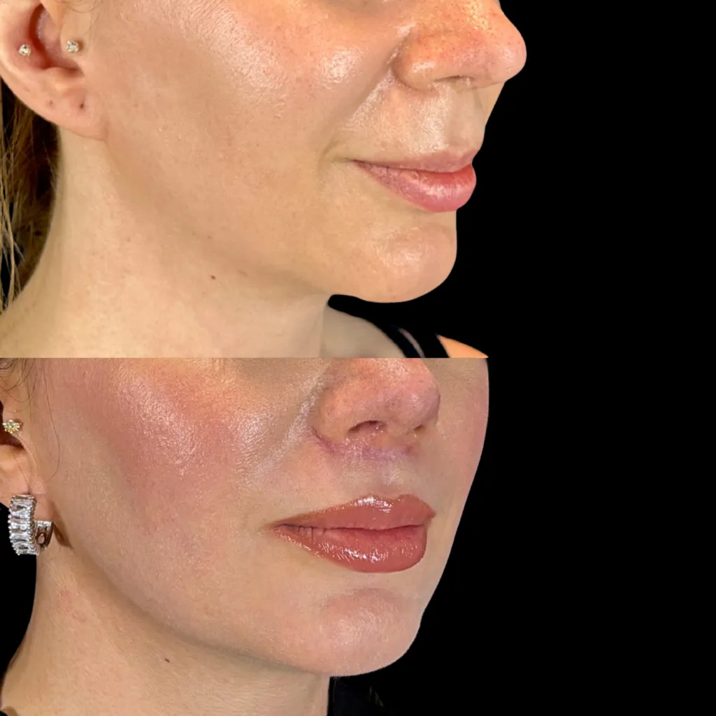 LipLift — öncesi ve sonrası